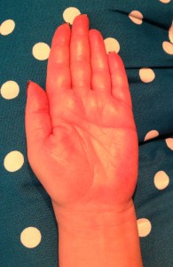 The last time my left hand will be scar-free.  (I don't care about the scar at all, by the way. I just want the hand to be pain-free!) Notice how swollen and shiny it is. Photo by Mr. X.