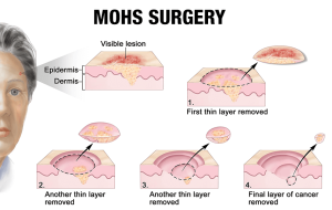 West-Valley-Dermatology-Mohs-Surgery