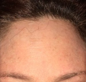 My intact forehead before surgery.  That minuscule dot in the bottom middle is where the offending cancer was. Photo by Mr. X.