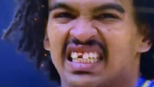 Skyy Clark's broken front tooth. Photo by Karen Salkin.